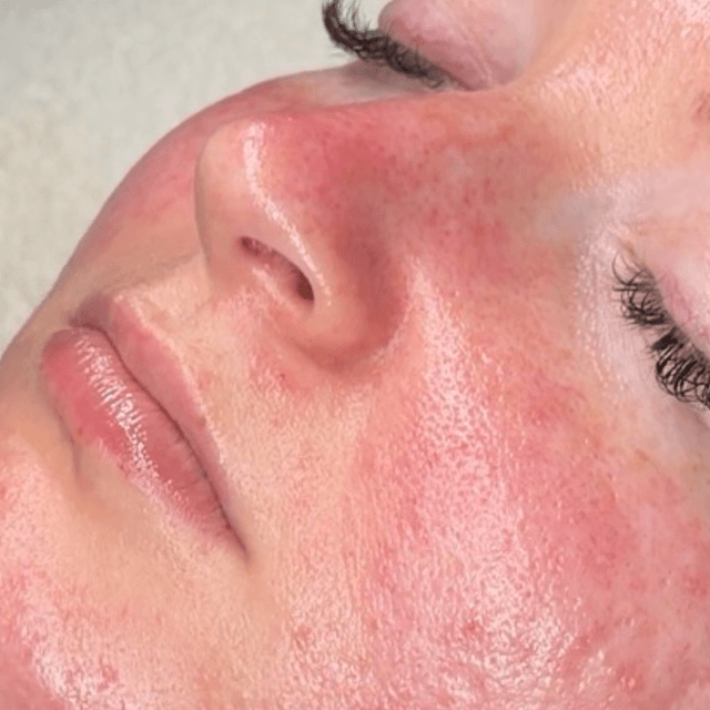 3 month glass skin at The Esthetic Era in Missoula, MT